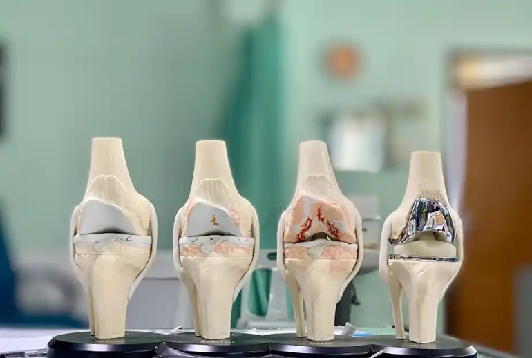 Knee Replacement Surgeon in East Delhi